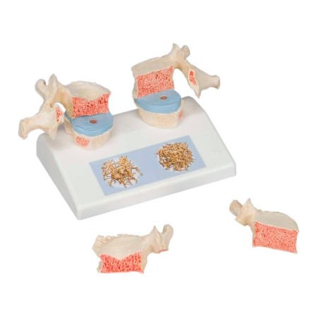 Fabrication Enterprises 3B Anatomical Model - Osteoporosis Model 966038